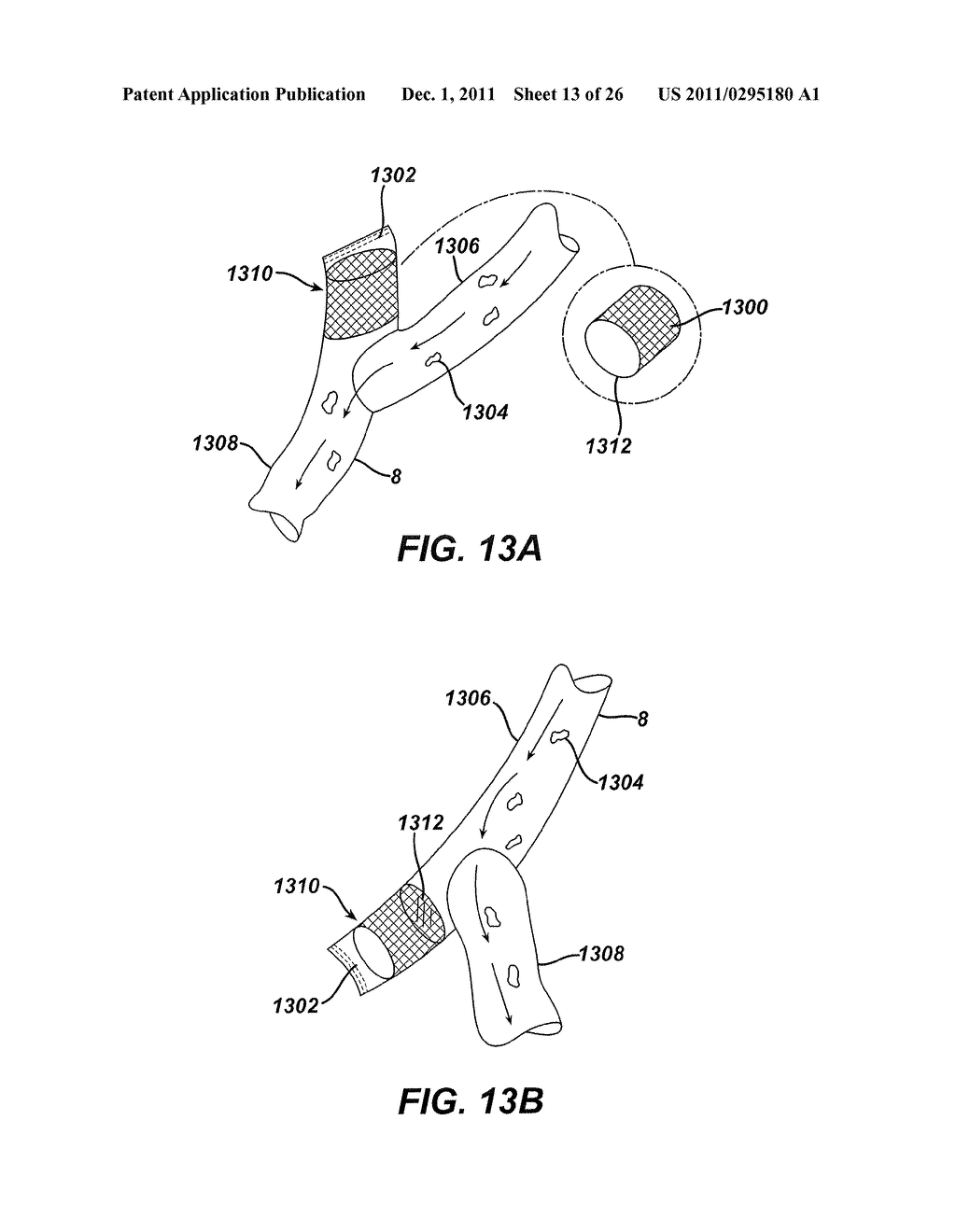 INTESTINAL BRAKE INDUCING INTRALUMINAL THERAPEUTIC SUBSTANCE ELUTING     DEVICES AND METHODS - diagram, schematic, and image 14