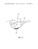 IMPLANTABLE AND REMOVABLE CUSTOMIZABLE BODY CONDUIT diagram and image