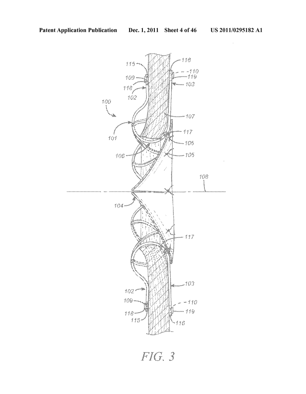 METHODS FOR LOADING A PROSTHESIS - diagram, schematic, and image 05