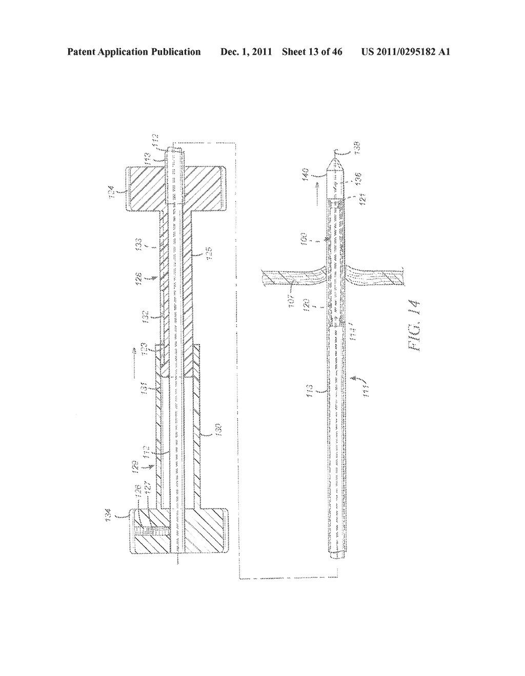 METHODS FOR LOADING A PROSTHESIS - diagram, schematic, and image 14