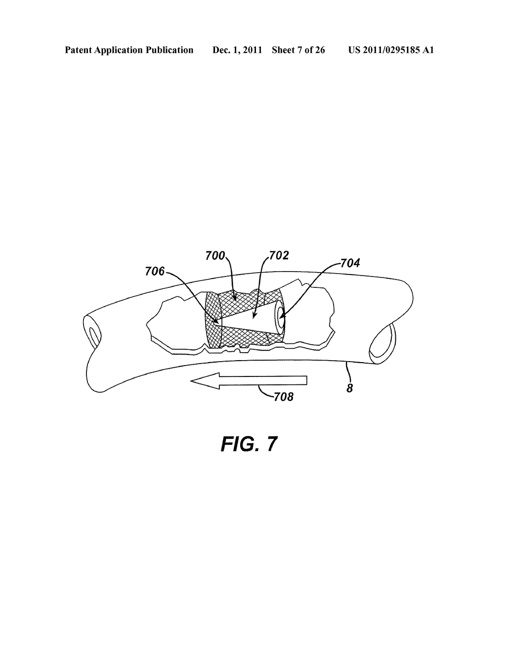 Intestinal Brake Inducing Intraluminal Therapeutic Substance Eluting     Devices and Methods - diagram, schematic, and image 08