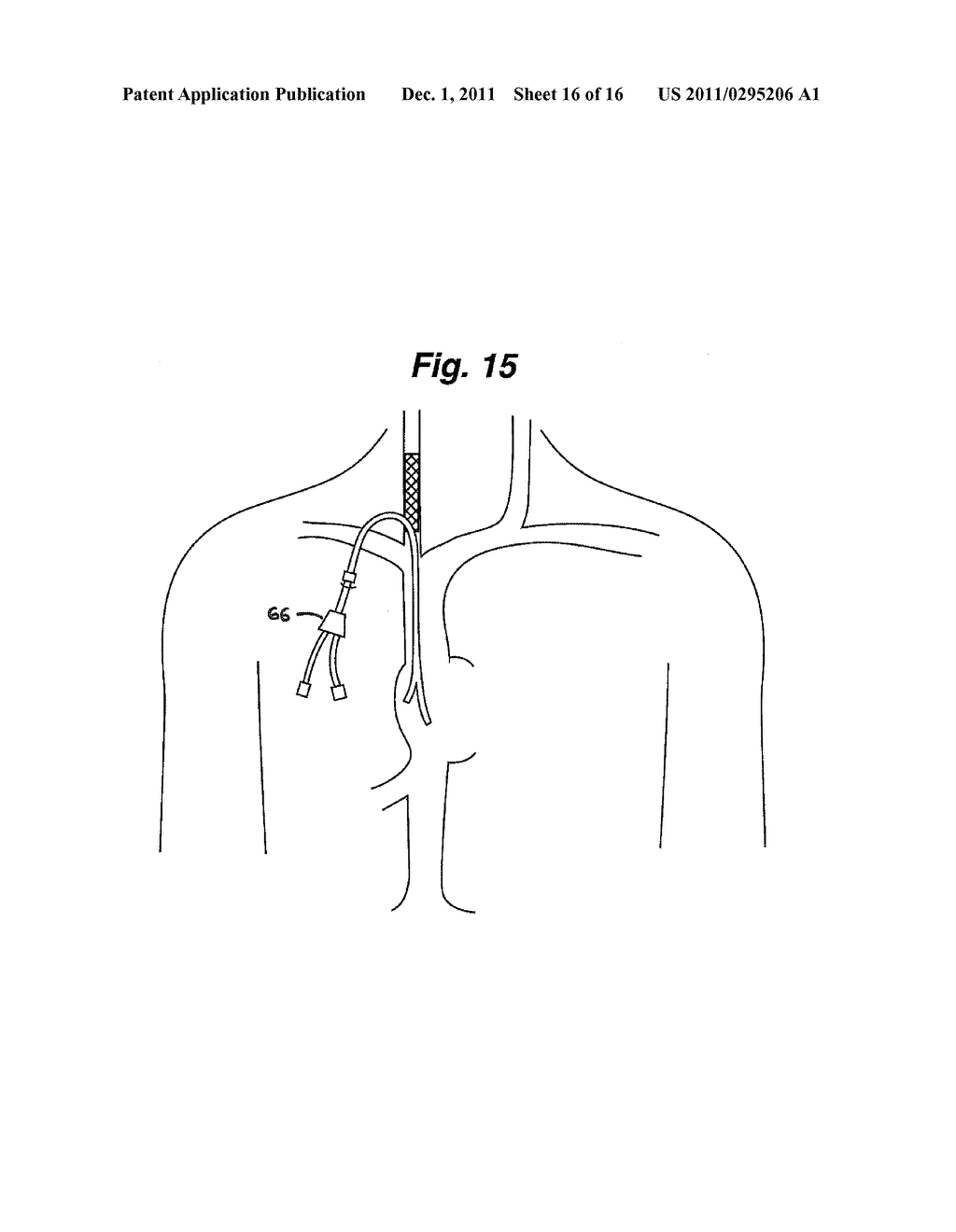 CENTRAL VENOUS ACCESS SYSTEM - diagram, schematic, and image 17