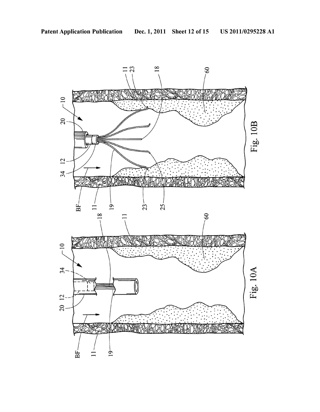 MINIMALLY INVASIVE MEDICAL DEVICE AND METHOD FOR DELIVERY OF THERAPEUTIC     OR DIAGNOSTIC AGENTS INTO A VESSEL WALL - diagram, schematic, and image 13