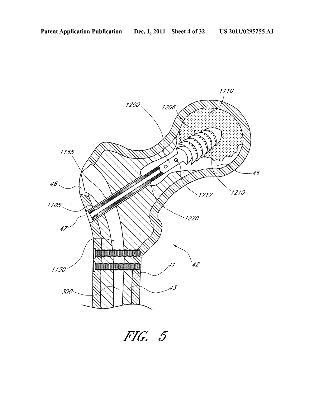 PROXIMAL FEMUR FIXATION APPARATUS, SYSTEMS AND METHODS WITH ANGLED     ELONGATE ELEMENTS - diagram, schematic, and image 05