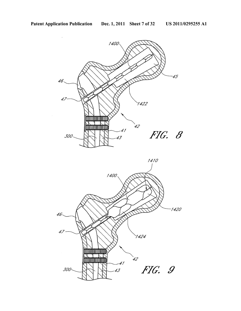 PROXIMAL FEMUR FIXATION APPARATUS, SYSTEMS AND METHODS WITH ANGLED     ELONGATE ELEMENTS - diagram, schematic, and image 08