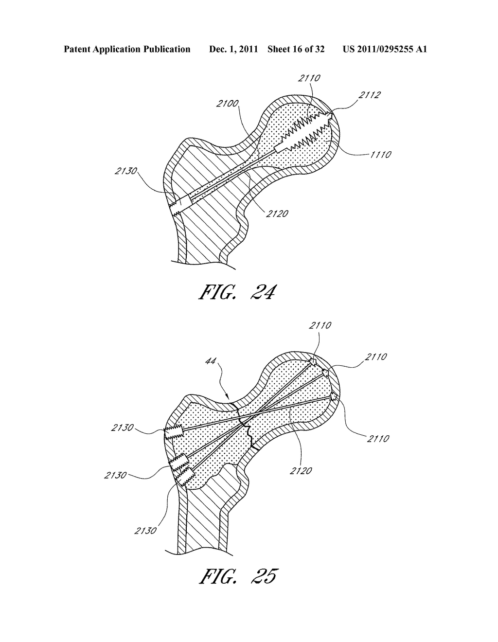 PROXIMAL FEMUR FIXATION APPARATUS, SYSTEMS AND METHODS WITH ANGLED     ELONGATE ELEMENTS - diagram, schematic, and image 17