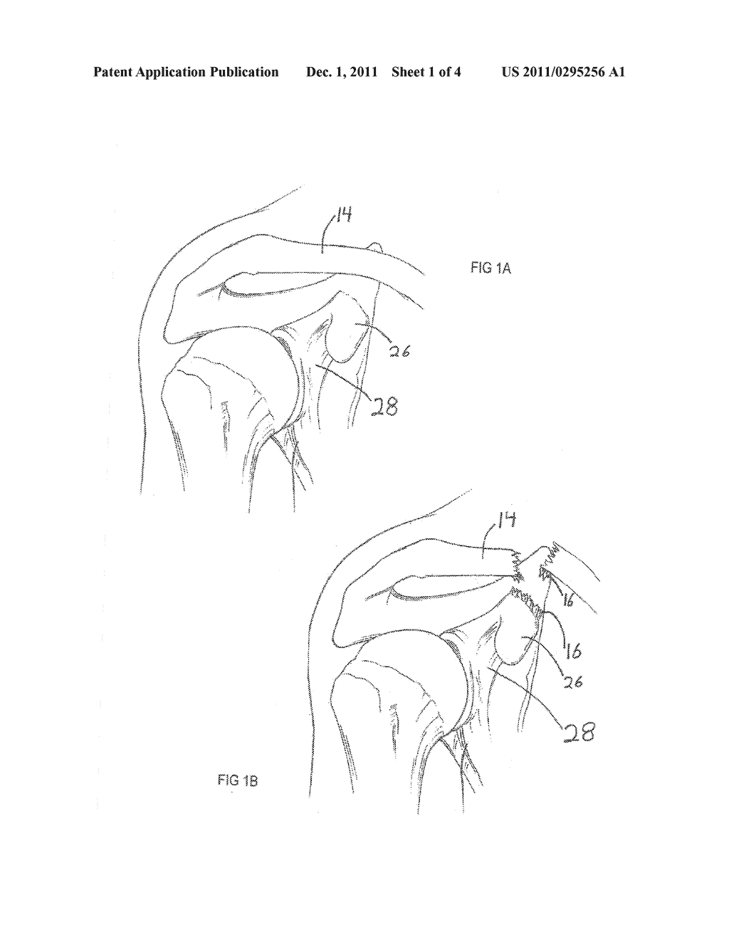 DISTAL CLAVICLE PLATE WITH CORACOID-CLAVICULAR LIGAMENT RECONSTRUCTION - diagram, schematic, and image 02