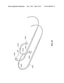 SYSTEMS AND METHODS FOR STERNUM REPAIR diagram and image