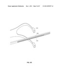 SYSTEMS AND METHODS FOR STERNUM REPAIR diagram and image