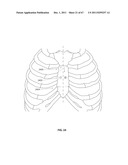 SYSTEMS AND METHODS FOR STERNUM REPAIR diagram and image