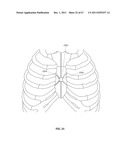 SYSTEMS AND METHODS FOR STERNUM REPAIR diagram and image