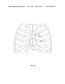 SYSTEMS AND METHODS FOR STERNUM REPAIR diagram and image