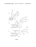 SYSTEMS AND METHODS FOR STERNUM REPAIR diagram and image