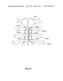 SYSTEMS AND METHODS FOR STERNUM REPAIR diagram and image