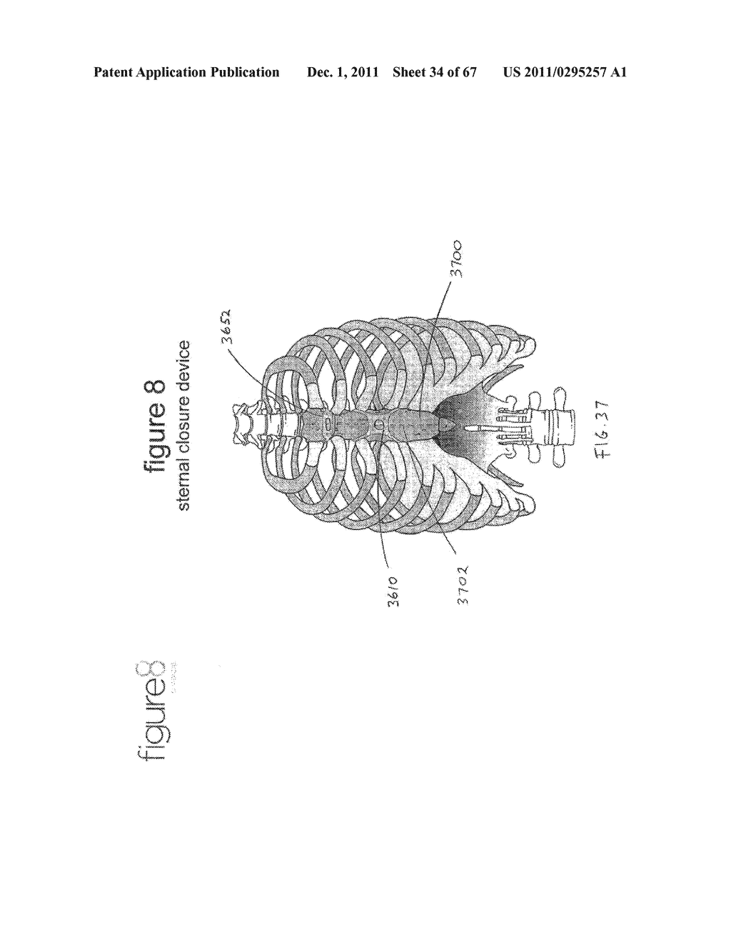 SYSTEMS AND METHODS FOR STERNUM REPAIR - diagram, schematic, and image 35