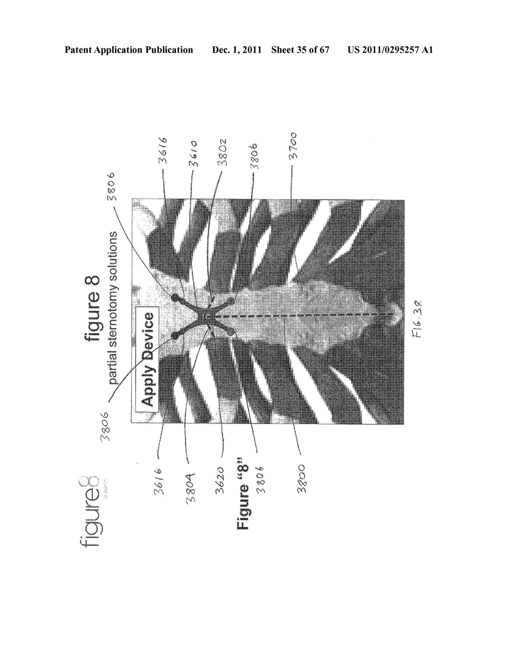 SYSTEMS AND METHODS FOR STERNUM REPAIR - diagram, schematic, and image 36