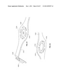 SYSTEMS AND METHODS FOR STERNUM REPAIR diagram and image