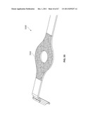 SYSTEMS AND METHODS FOR STERNUM REPAIR diagram and image