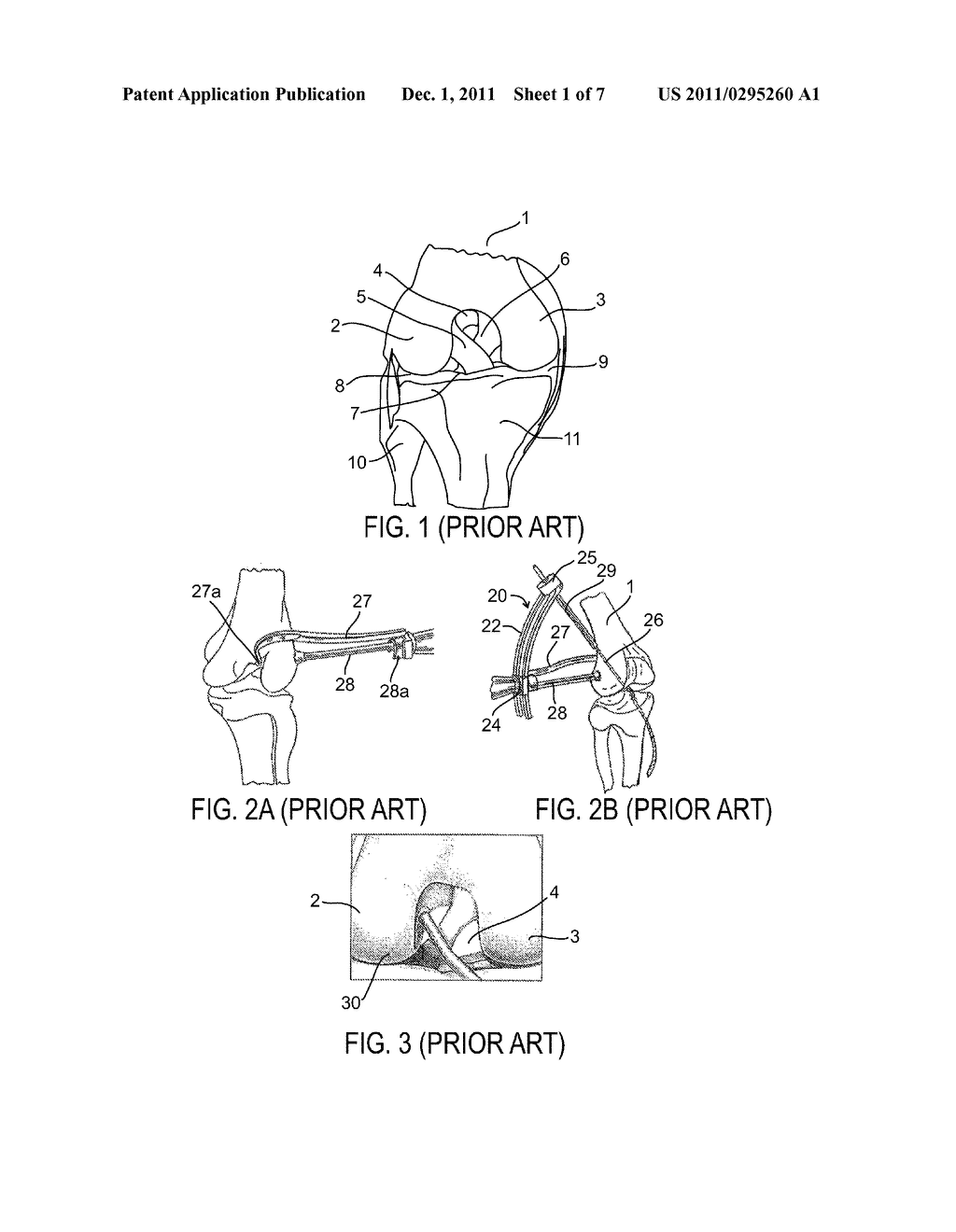 KNEE RECONSTRUCTION PROCEDURE AND SURGICAL IMPLEMENT PARTICULARLY USEFUL     FOR SUCH KNEE RECONSTRUCTION PROCEDURE - diagram, schematic, and image 02