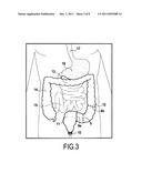 SURGICAL DEVICE FOR THE TEMPORARY PROTECTION OF ANASTOMOSIS diagram and image