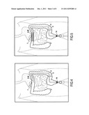 SURGICAL DEVICE FOR THE TEMPORARY PROTECTION OF ANASTOMOSIS diagram and image