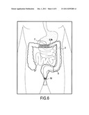 SURGICAL DEVICE FOR THE TEMPORARY PROTECTION OF ANASTOMOSIS diagram and image