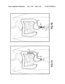 SURGICAL DEVICE FOR THE TEMPORARY PROTECTION OF ANASTOMOSIS diagram and image