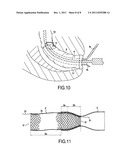 SURGICAL DEVICE FOR THE TEMPORARY PROTECTION OF ANASTOMOSIS diagram and image