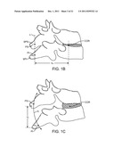 METHODS AND SYSTEMS FOR INCREASING THE BENDING STIFFNESS AND CONSTRAINING     THE SPREADING OF A SPINAL SEGMENT diagram and image