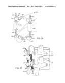 METHODS AND SYSTEMS FOR INCREASING THE BENDING STIFFNESS AND CONSTRAINING     THE SPREADING OF A SPINAL SEGMENT diagram and image