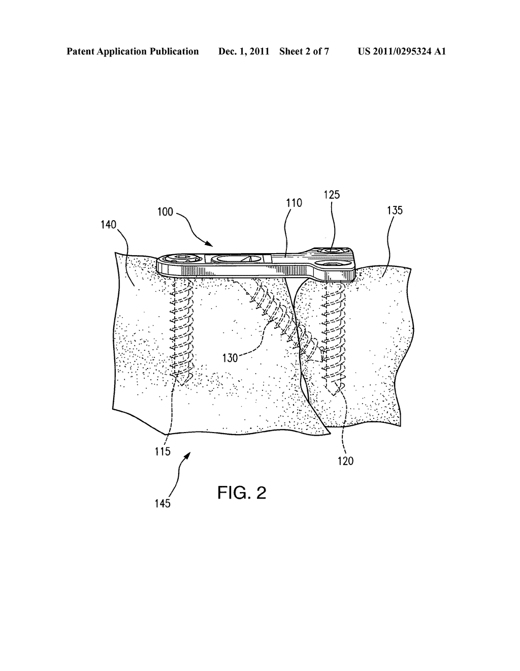 TABBED COMPRESSION PLATE AND METHOD OF USE - diagram, schematic, and image 03