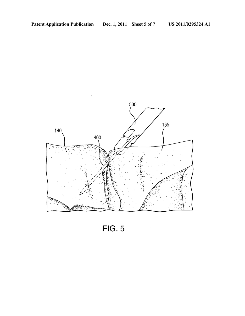 TABBED COMPRESSION PLATE AND METHOD OF USE - diagram, schematic, and image 06