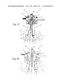 Method and Apparatus for Performing Spinal Surgery diagram and image