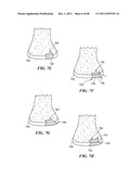 Patient Selectable Joint Arthroplasty Devices and Surgical Tools diagram and image