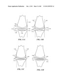 Patient Selectable Joint Arthroplasty Devices and Surgical Tools diagram and image