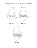 Patient Selectable Joint Arthroplasty Devices and Surgical Tools diagram and image