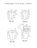 Patient Selectable Joint Arthroplasty Devices and Surgical Tools diagram and image