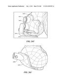 Patient Selectable Joint Arthroplasty Devices and Surgical Tools diagram and image