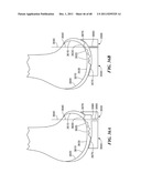 Patient Selectable Joint Arthroplasty Devices and Surgical Tools diagram and image