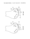 Patient Selectable Joint Arthroplasty Devices and Surgical Tools diagram and image