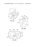 Patient Selectable Joint Arthroplasty Devices and Surgical Tools diagram and image