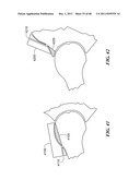 Patient Selectable Joint Arthroplasty Devices and Surgical Tools diagram and image