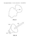 Patient Selectable Joint Arthroplasty Devices and Surgical Tools diagram and image