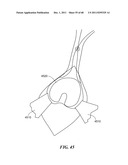 Patient Selectable Joint Arthroplasty Devices and Surgical Tools diagram and image