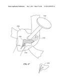 Patient Selectable Joint Arthroplasty Devices and Surgical Tools diagram and image