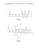 ANCHORING UNITS FOR LEADS OF IMPLANTABLE ELECTRIC STIMULATION SYSTEMS AND     METHODS OF MAKING AND USING diagram and image