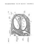 LASER-BASED NERVE STIMULATORS FOR, E.G., HEARING RESTORATION IN COCHLEAR     PROSTHESES AND METHOD diagram and image