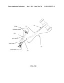 BI-DIRECTIONAL FIXATING TRANSVERTEBRAL BODY SCREWS AND POSTERIOR CERVICAL     AND LUMBAR INTERARTICULATING JOINT CALIBRATED STAPLING DEVICES FOR SPINAL     FUSION diagram and image