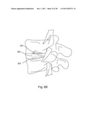 BI-DIRECTIONAL FIXATING TRANSVERTEBRAL BODY SCREWS AND POSTERIOR CERVICAL     AND LUMBAR INTERARTICULATING JOINT CALIBRATED STAPLING DEVICES FOR SPINAL     FUSION diagram and image