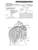 Allogenic Articular Cavity Prosthesis and Method for Implanting the Same diagram and image